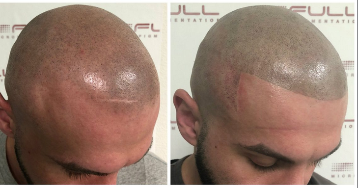 Scalp Micropigmentation- A Solution For Hairloss